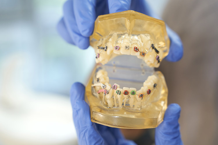 Today’s Metal Braces Different from those of the Past At Sequence Orthodontics