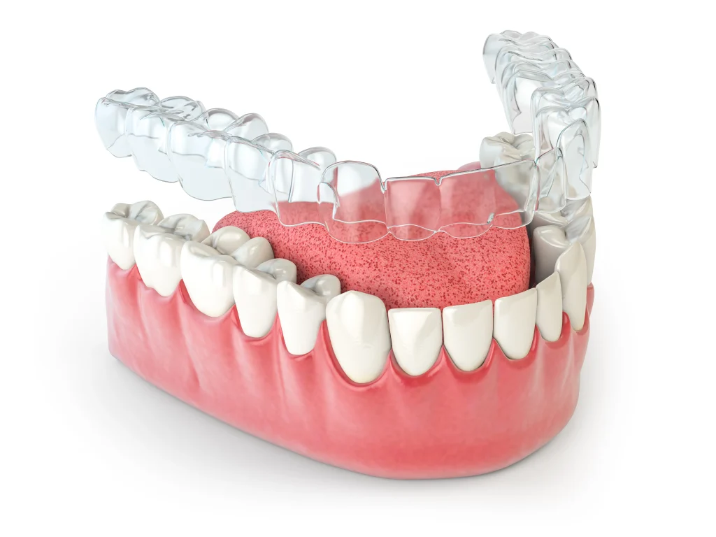 Retainers for Teeth: What Are They and Why Wear Them